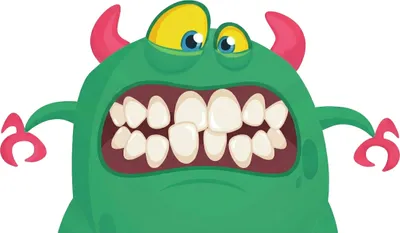 Illustration of Anterior Crossbite