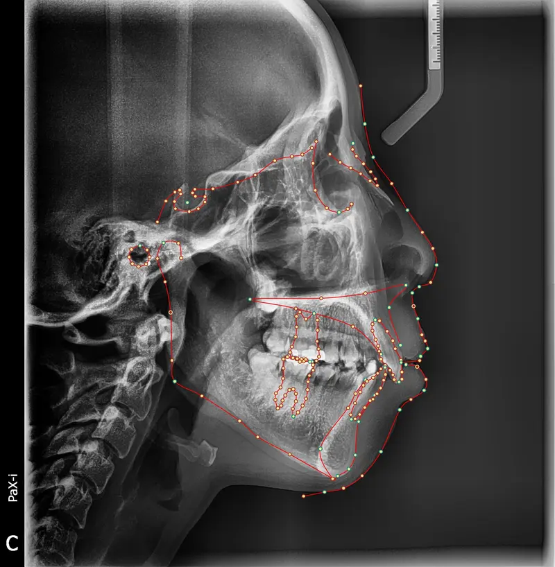 Cephalometric tracing