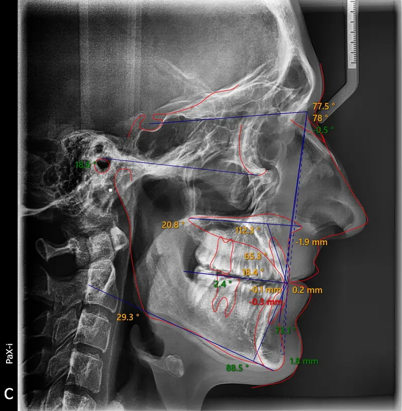 Cephalometric tracing