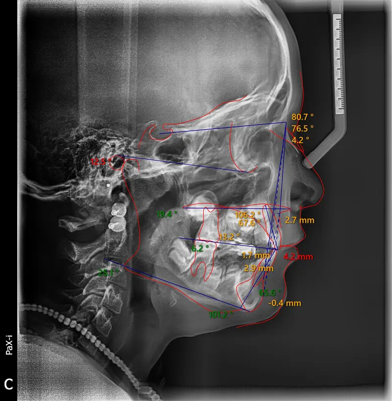 Cephalometric tracing