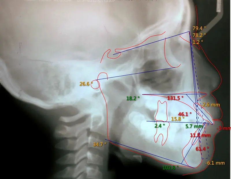 Cephalometric tracing