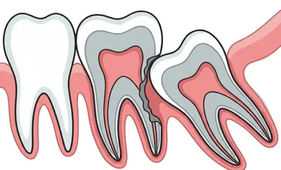 Illustration of Ectopic Eruption
