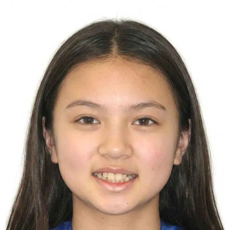 Before treatment: Crossbite & Smile Arc