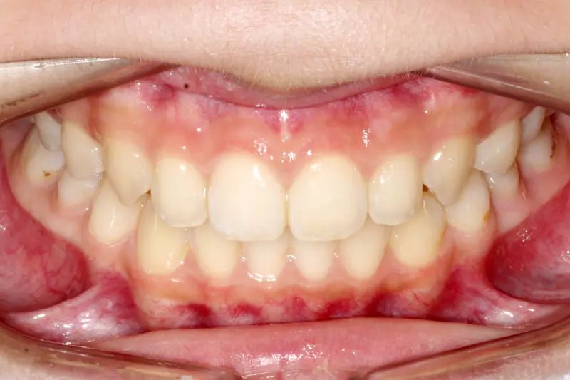 After treatment: Intraoral Occlusal Comparison