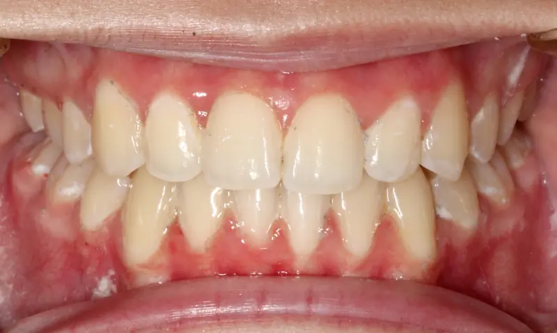 After treatment: Intraoral Occlusal Comparison