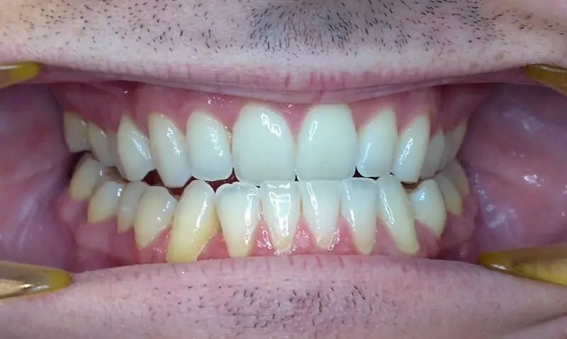 Before treatment: Intraoral Occlusal Comparison