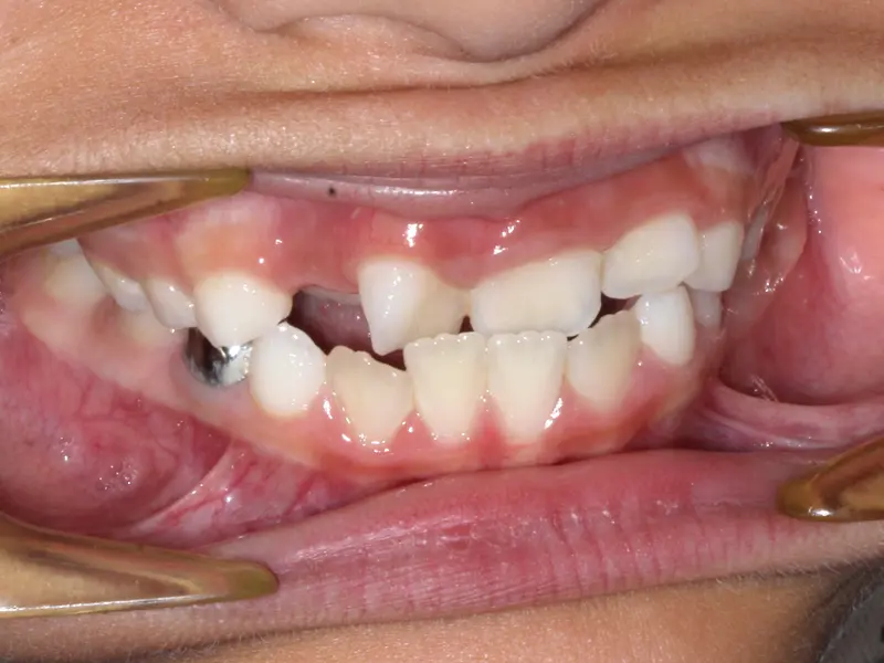 Before treatment: Intraoral Occlusal Comparison