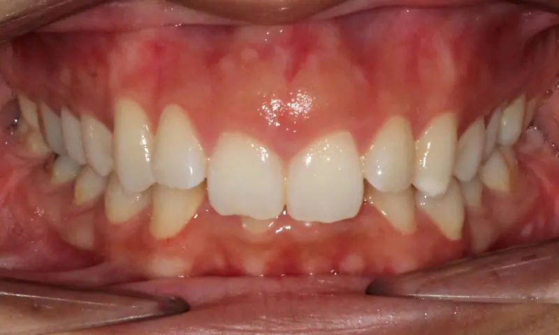 Before treatment: Intraoral Occlusal Comparison
